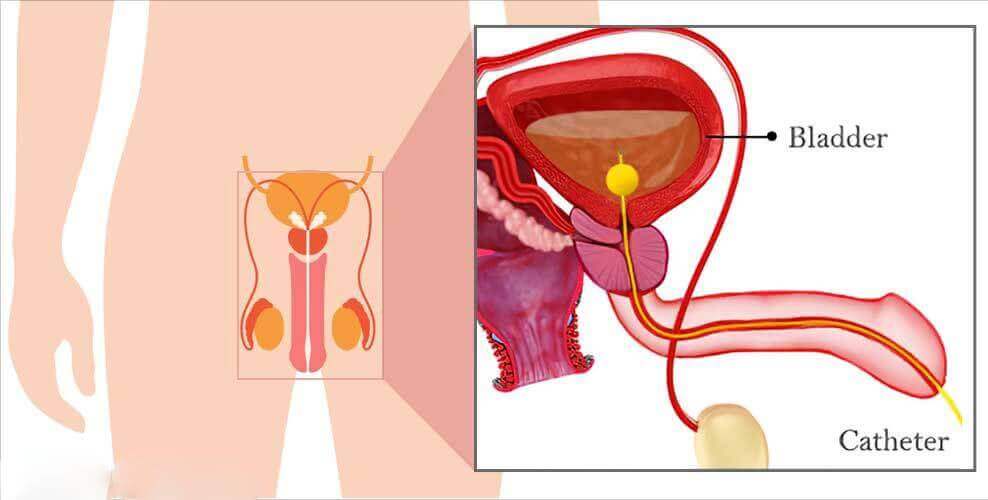 Urodynamic (UDS)